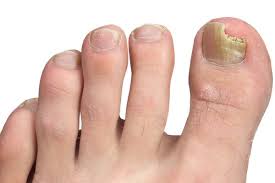 Fungal infection presentation